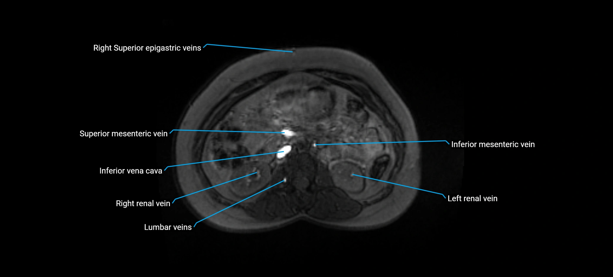 MRV abdomen pelvis & lower limb axial cross sectional anatomy labelled MRI image 75 (1).webp